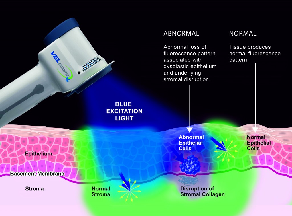 VELscope_-_Mechanism_of_action_Illustration_-_v03_14_